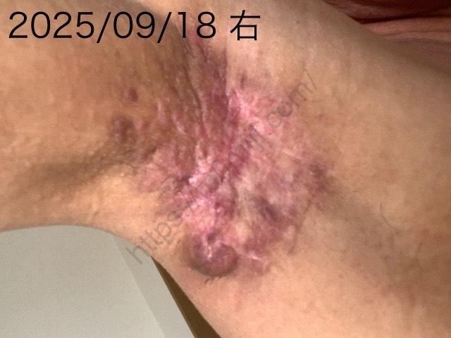 わきが手術後　右　経過状況　2025年9月18日